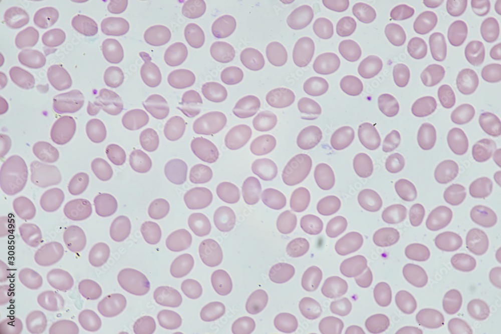 Abnormal red blood cell Abnormal red blood cell