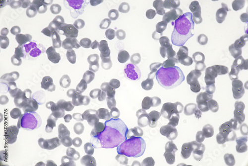 Canvas Print Blast cell (Acute myeloid leukemia in Human)