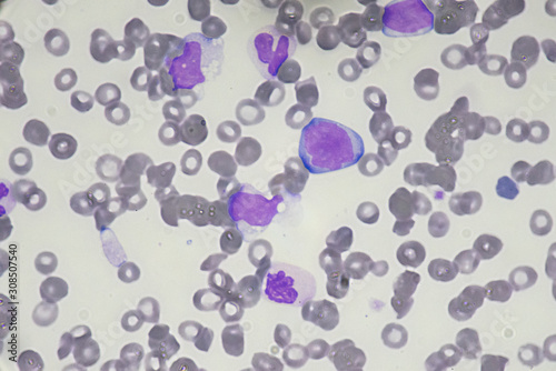 Blast cell (Acute myeloid leukemia in Human)