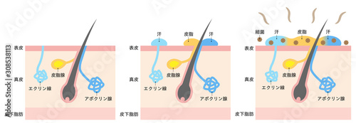 体臭の原因と汗腺　肌の断面図