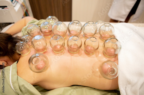patience undergoing of chinese cupping therapy