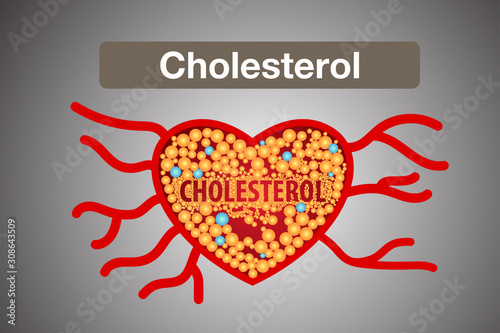 Cholesterol in artery, health risk , vector design