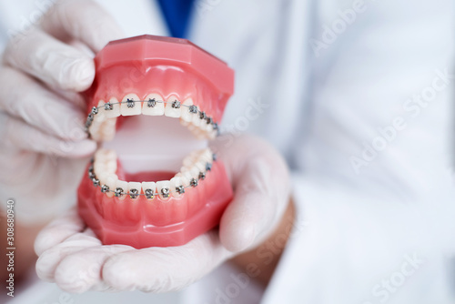 doctor orthodontist shows how the system of braces on teeth is arranged photo