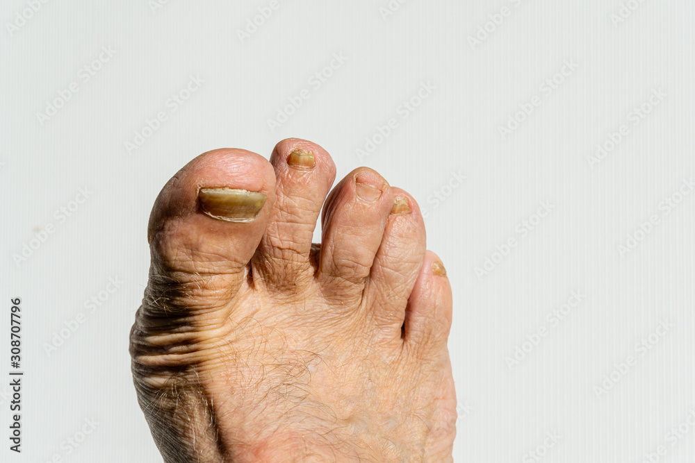 Fungus on nail plate of right leg on white background. All nail plates on foot is affected and mutilated by infection. Toenails are broken and peeling. Deformation of nail plate from nail fungus. Fungus on nail plate of right leg on white background. All nail plates on foot is affected and mutilated by infection. Toenails are broken and peeling. Deformation of nail plate from nail fungus.