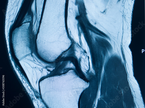 Knee injury mri mcl tear