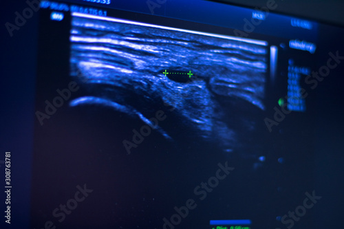 EPI dry needling ultrasound scan