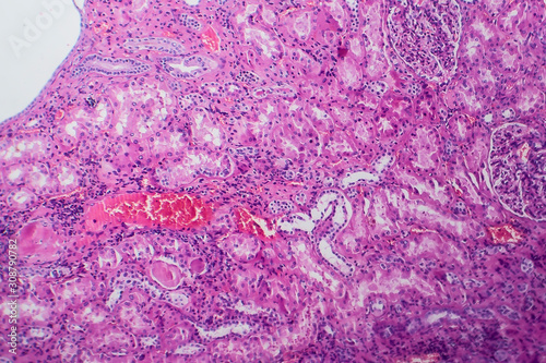 Histopathology of hypertensive renal disease, light micrograph, photo under microscope