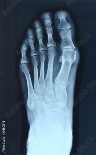 Plakat w ramie X-ray normal human foot . Top view . 