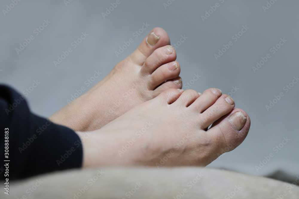 damaged nails of woman's feet damaged nails of woman's feet