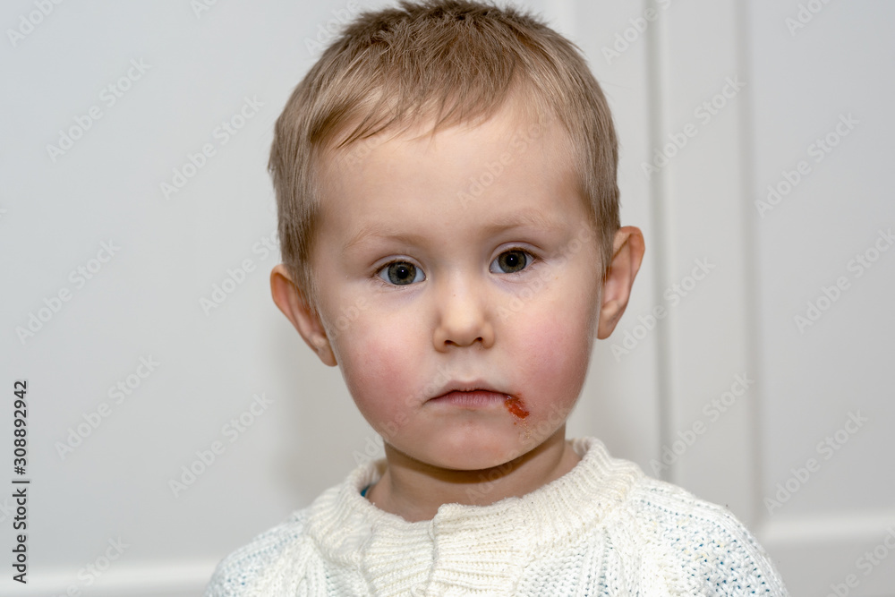 Acute herpetic stomatitis in children is an infectious viral disease caused by primary contact with the herpes simplex virus