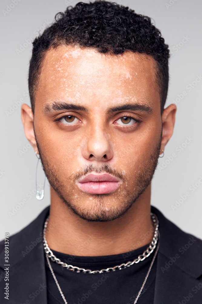 Obraz premium Studio Portrait Of Young Man With Skin Pigmentation Disorder Looking At Camera