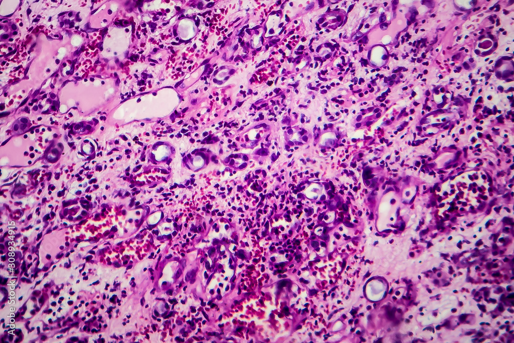 Histopathology of interstitial nephritis, light micrograph, photo under ...