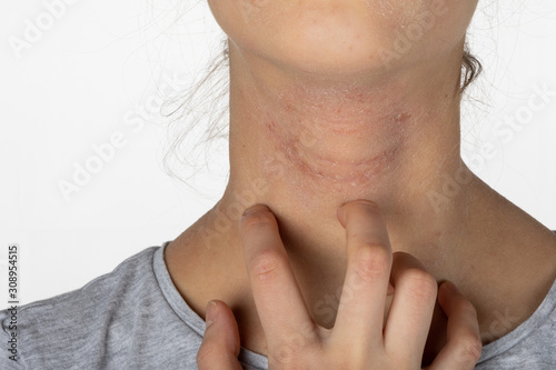 Allergic itchy skin on girl neck. Teen with rash dry skin scratching her neck. Dermatological problem. Girl with atopic dermatitis. Allergy concept