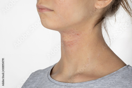Allergic itchy skin on girl neck. Teen with rash dry skin on neck. Dermatological problem. Girl with atopic dermatitis. Allergy concept