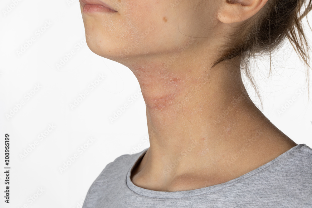Allergic itchy skin on girl neck. Teen with rash dry skin on neck. Dermatological problem. Girl with atopic dermatitis. Allergy concept Allergic itchy skin on girl neck. Teen with rash dry skin on neck. Dermatological problem. Girl with atopic dermatitis. Allergy concept