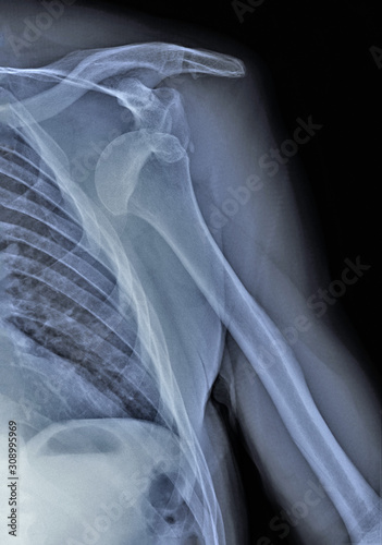 x ray of the shoulder joint with dislocation of the head of the humerus photo