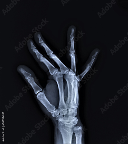 x-ray of hand bones, diagnosis of diseases
