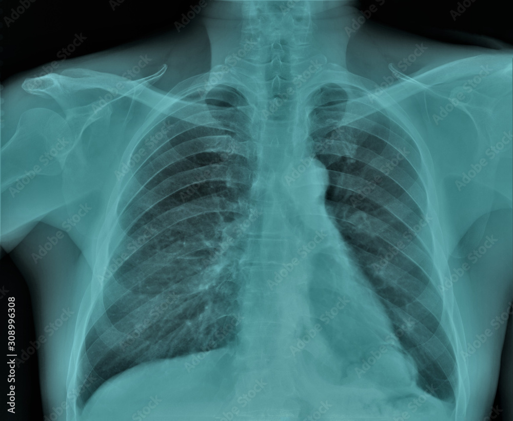 chest x-ray, pneumonia, emphysema, pulmonology, diagnosis of diseases chest x-ray, pneumonia, emphysema, pulmonology, diagnosis of diseases