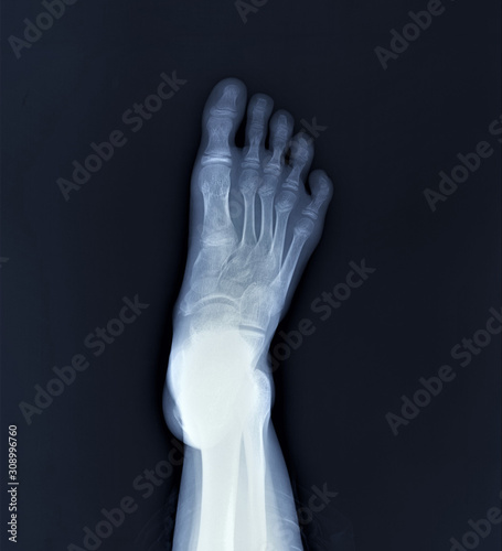 normal radiography of the foot, medical diagnostics, traumatology and orthopedics, rheumatology