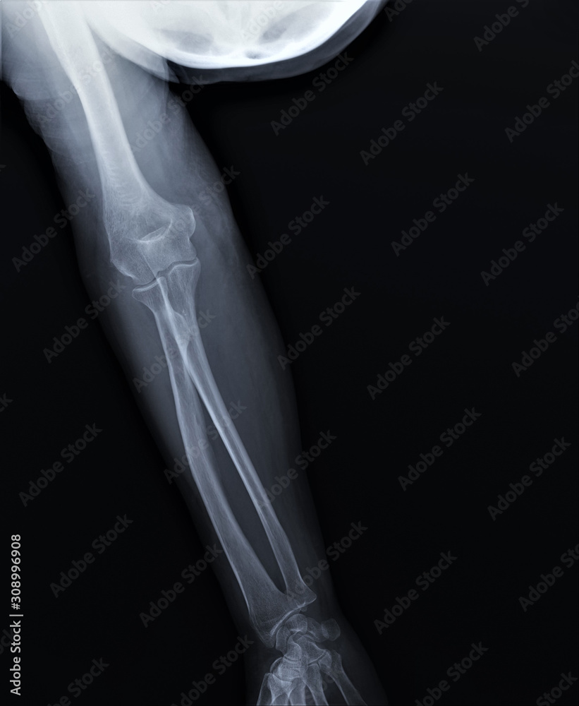 x-ray of the normal elbow joint. traumatology and orthopedics, medical diagnostics, rheumatology