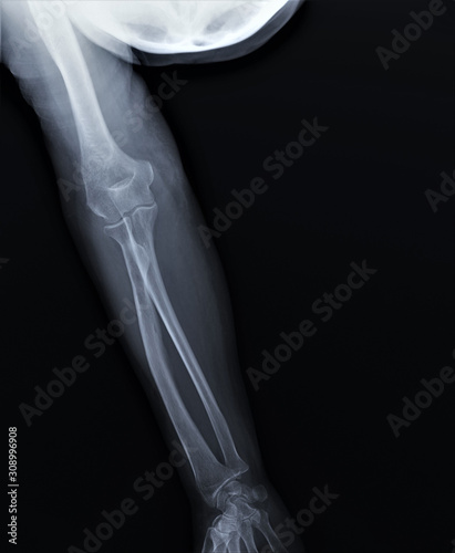 x-ray of the normal elbow joint. traumatology and orthopedics  medical diagnostics  rheumatology