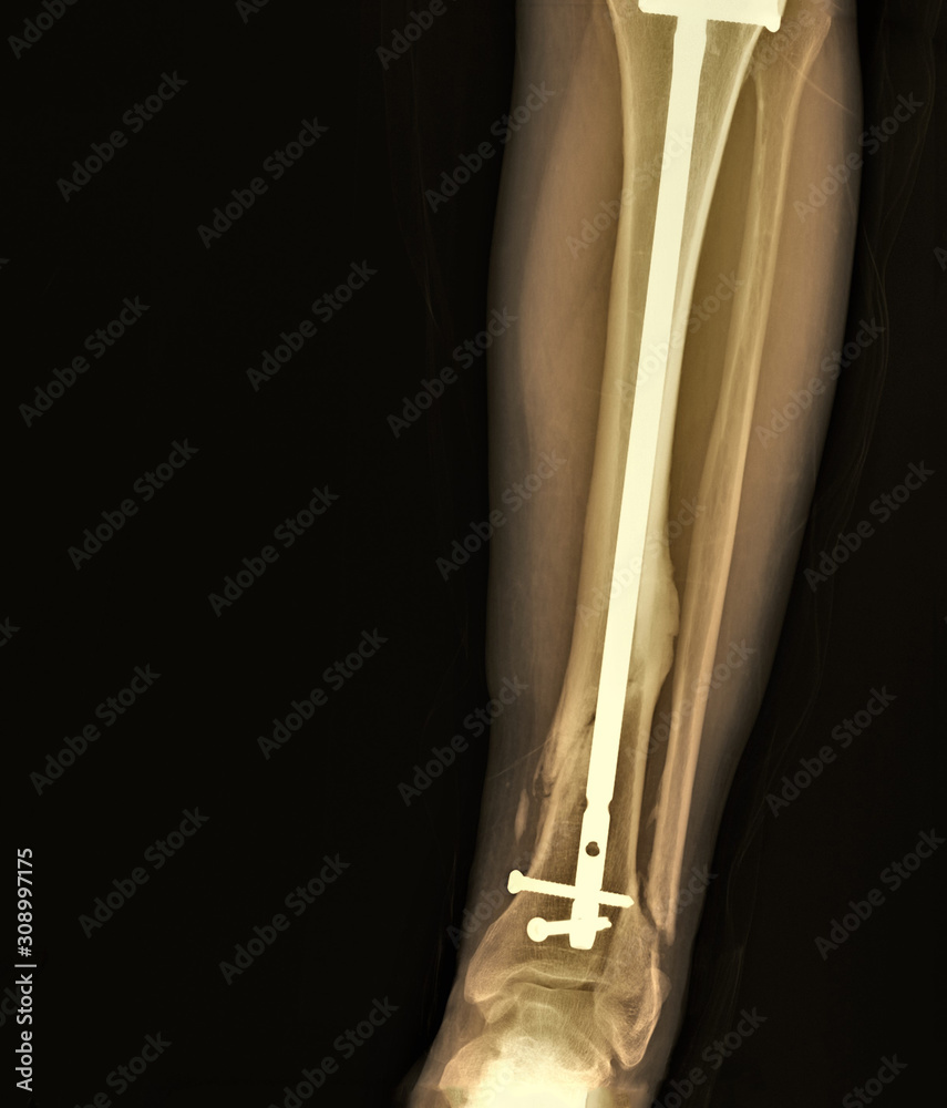 An x-ray of an intramedullary nail for a tibial fracture Stock Photo - Alamy
