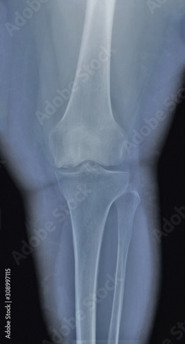 x ray of the knee joint   medical diagnostics  traumatology and orthopedics