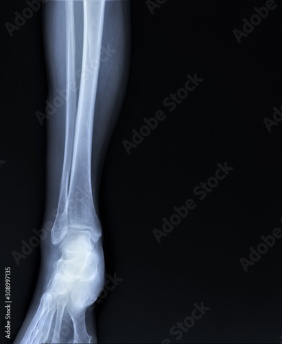 normal radiograph of the ankle joint in front projection