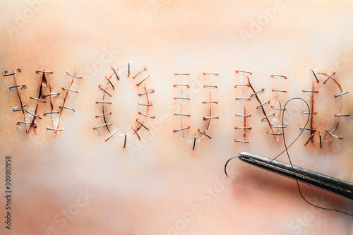 Surgical stitches, suture wound