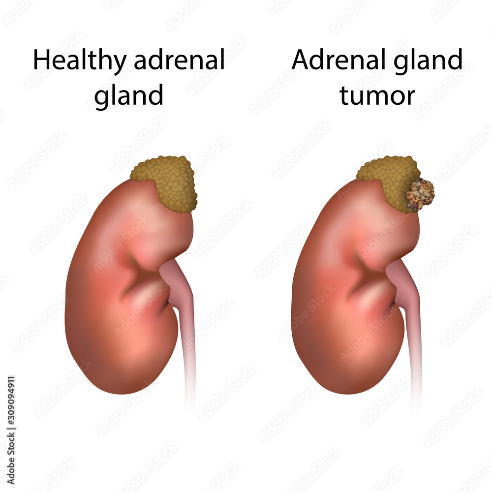 Adrenal Gland Tumor