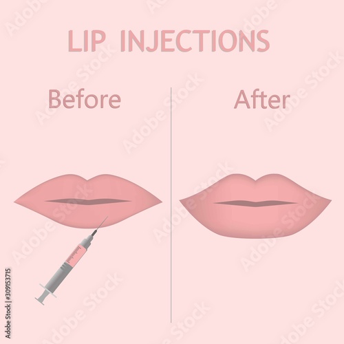 Vector illustration of lip injection with  syringe ,before and after on pink background. Lip Augmentation in flat style