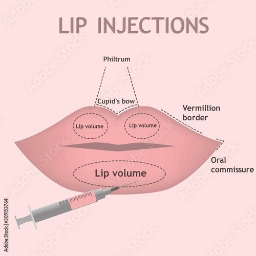 Vector illustration of anatomy of lips on pink background. Info graphic of lip injections .Augmentation procedure isolated.