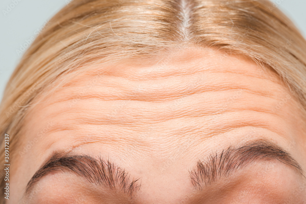 close up of forehead with wrinkles of woman close up of forehead with wrinkles of woman