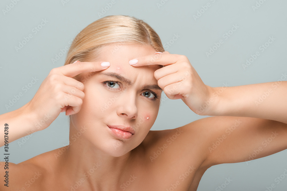 displeased girl pointing with fingers at face with acne isolated on grey displeased girl pointing with fingers at face with acne isolated on grey