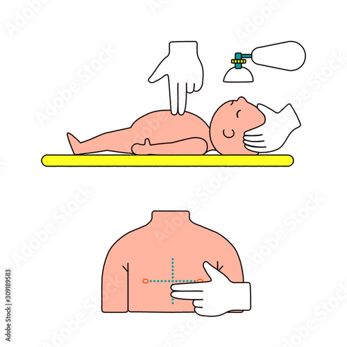 Chest compressions for babys