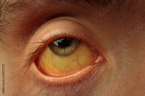 yellow staining of the sclera of the eye in diseases of the liver, cirrhosis, hepatitis, bilirubin, selective focus