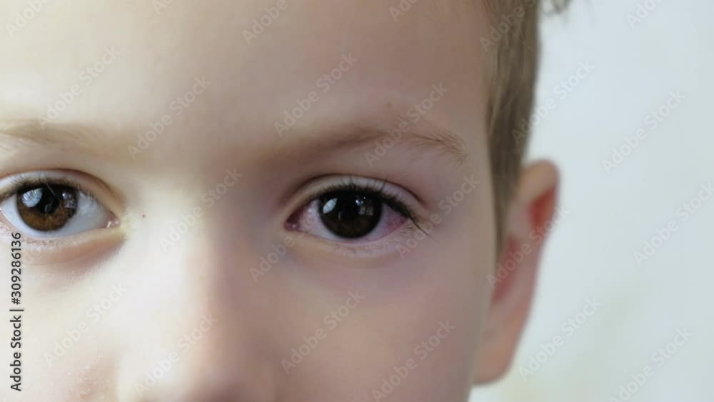 4K Close up. Little boy shows the eyes with conjunctivitis. The viral on eye. 4K Close up. Little boy shows the eyes with conjunctivitis. The viral on eye.