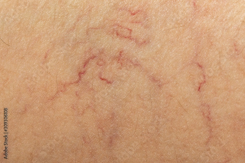 The texture of the background, varicose veins on human skin.