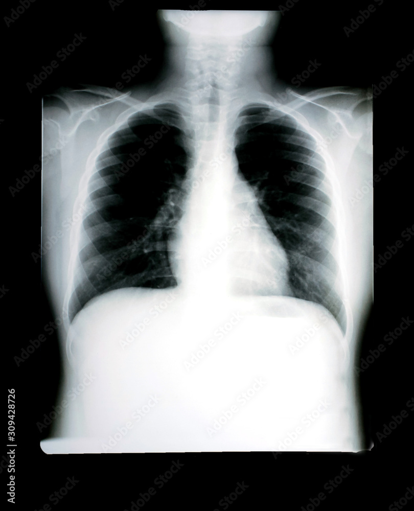 Chest x-ray film photos And the respiratory system for diagnosis in the ...