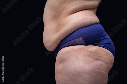 Fat female body