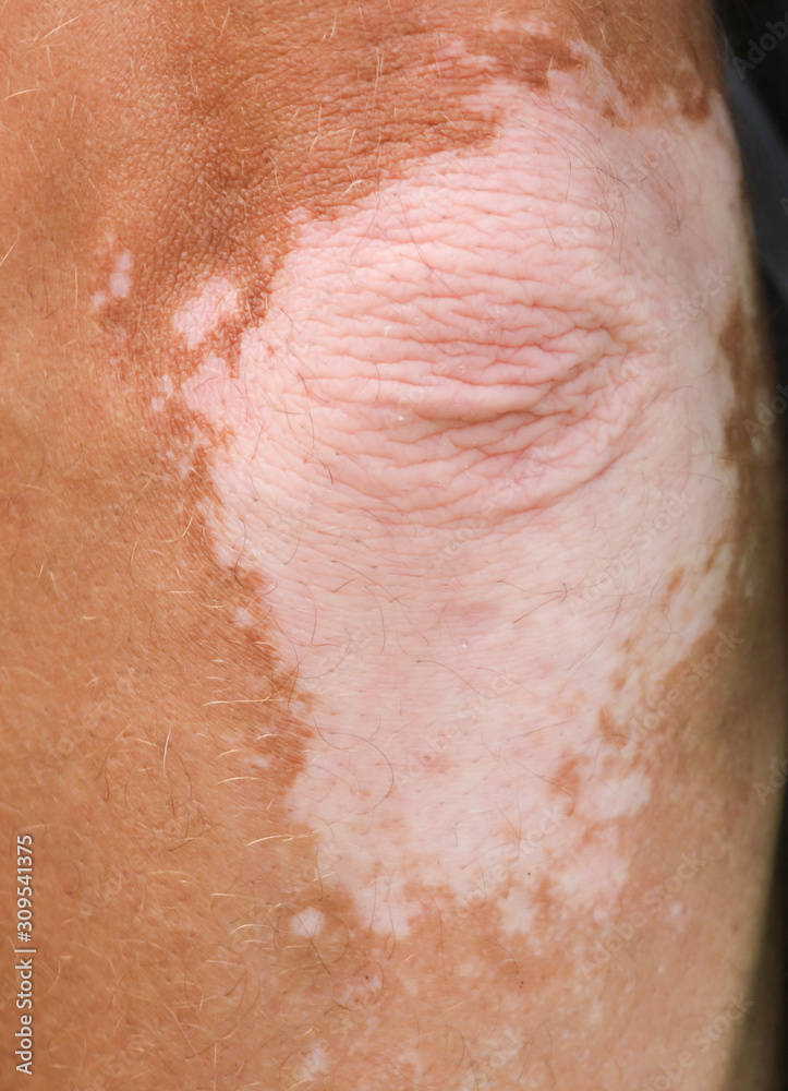 Fototapeta premium White spots on the hand