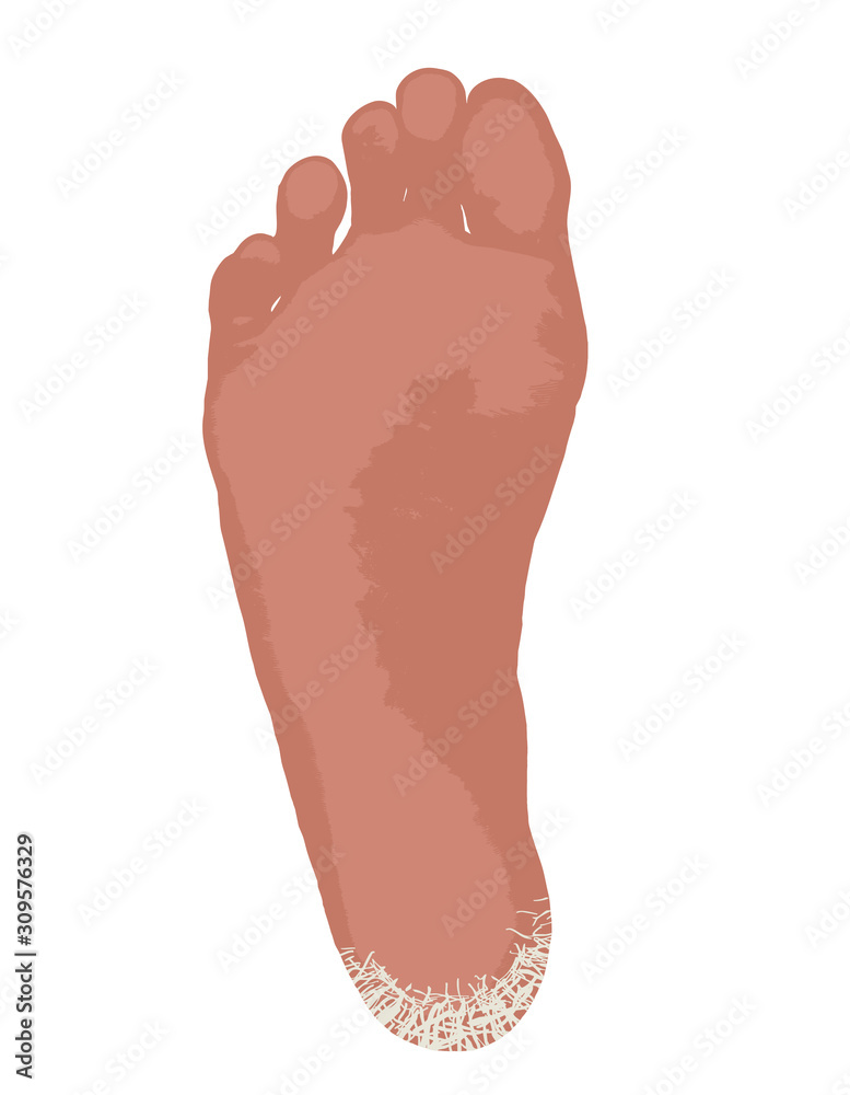 Fototapeta premium 乾燥でひび割れたかかと