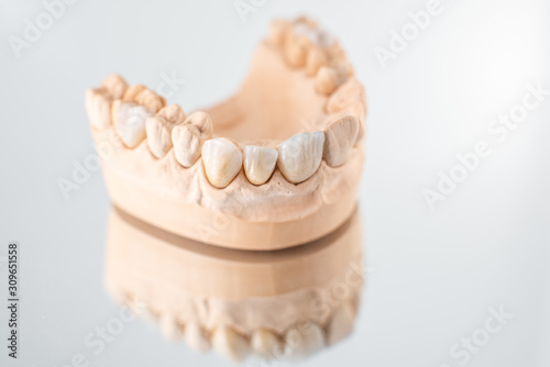 Close-up on plaster model of artificial jaw with veneers on the mirror background. Concept of aesthetic dentistry and design of veneers