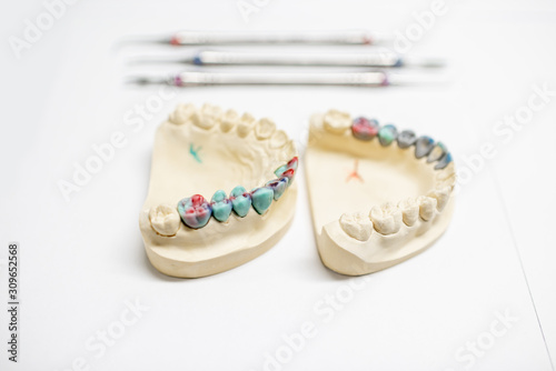 Plaster models of artificial jaw with painted dental prosthesis on the white background. Concept of aesthetic dentistry and implantation