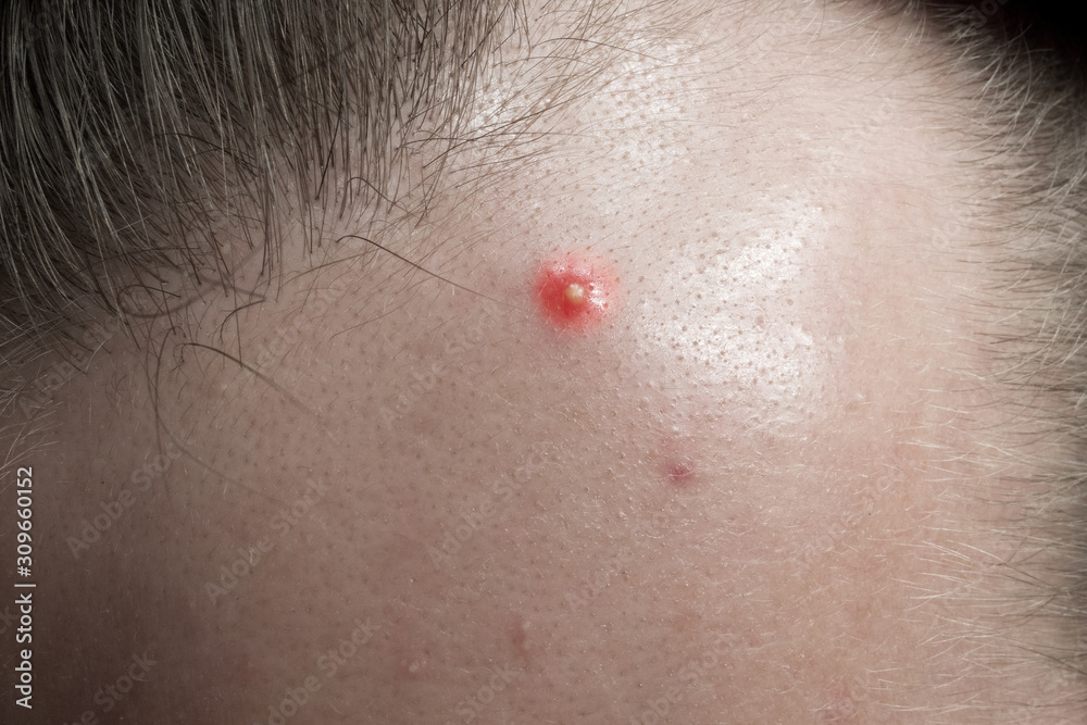 Fototapeta premium pimple on the forehead close-up, acne