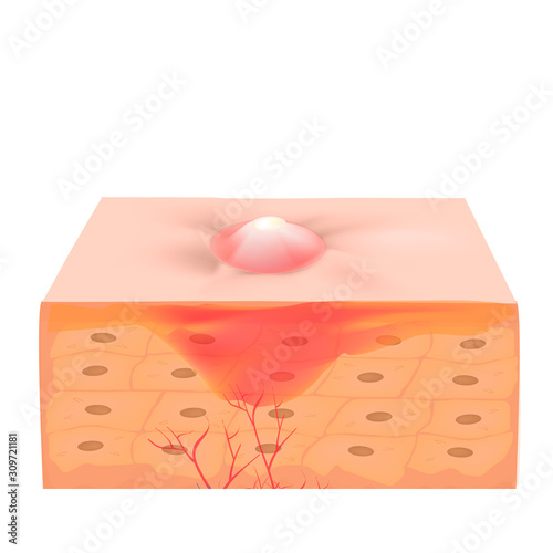 Inflamed acne on the skin. Inflamed pimple. The structure of the skin. Infographics. Vector illustration on isolated background.