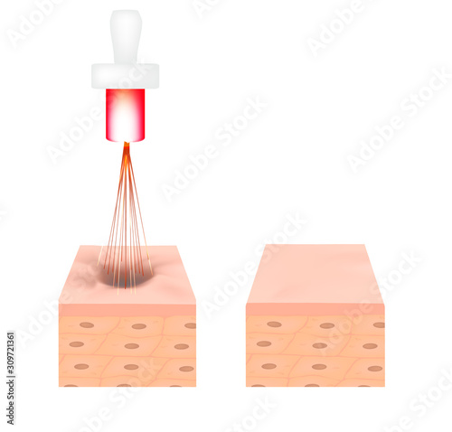 Acne scars. Laser scar atrophic treatment. The anatomical structure of the skin with acne. Vector illustration on isolated background.