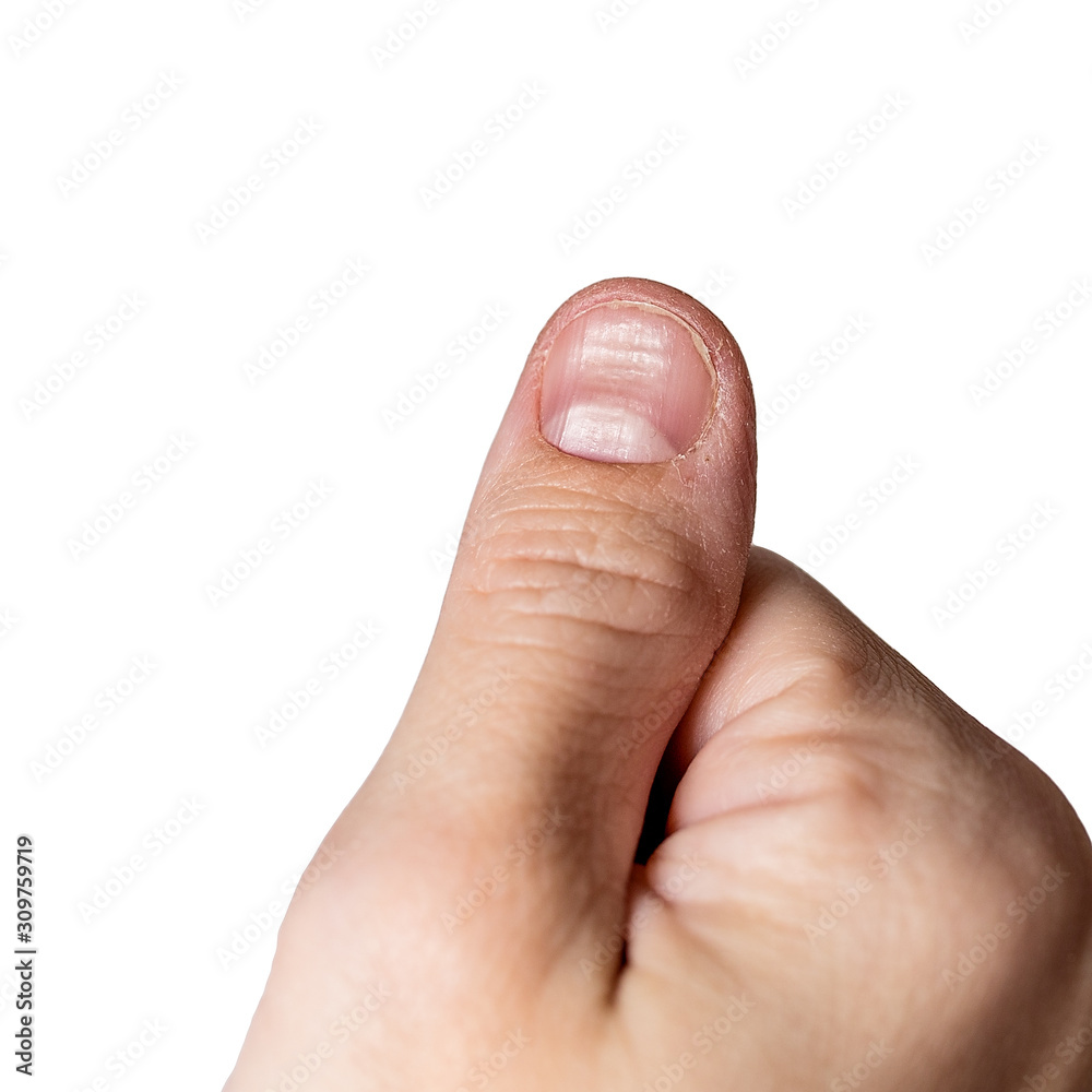 Nail disease, beriberi Nail disease, beriberi