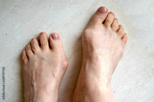 Hallux valgus, big abnormal feet bones.  Bunion on big toes of female feet isolated on light background photo