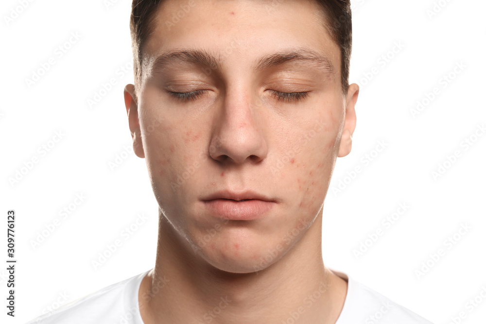 Obraz premium Teen guy with acne problem on white background, closeup